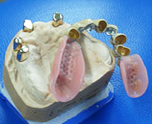 Zahnersatz abnehmbare Prothese